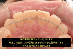 部分矯正による歯のガタガタ（叢生）が治りました。裏側を保定ワイヤーで止めます。